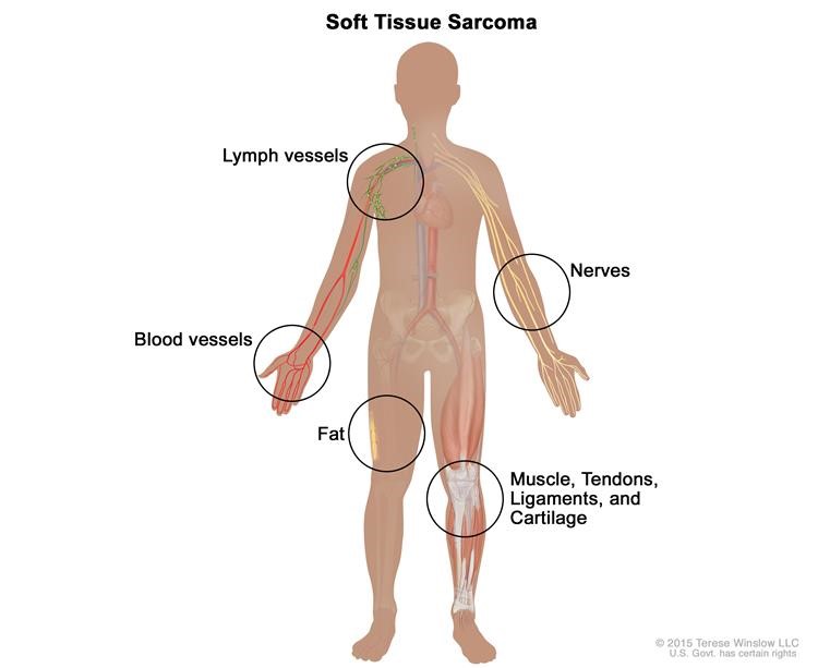 Soft Tissue Sarcomas - Let's Cure Sarcoma